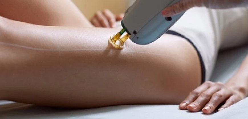 Αποτρίχωση λέιζερ: Η νέα μόδα – Ποιοι οι κίνδυνοι;